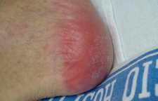 زخم بستر چیست؟