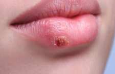 دلایل ایجاد تبخال  و درمان آن