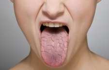 درمان خشکی دهان