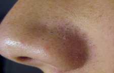 راه های درمان و از بین بردن جوش های سر سیاه