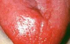 عوارض التهاب زبان یا گلوسیت چیست