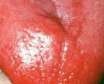 عوارض التهاب زبان یا گلوسیت چیست