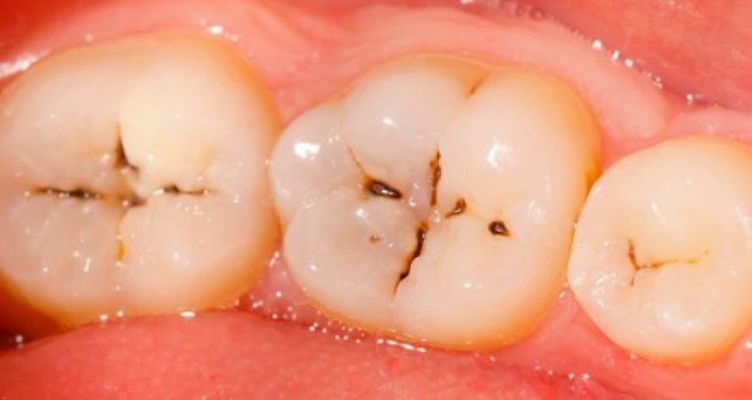 عوامل پوسیدگی دندان را بشناسیم
