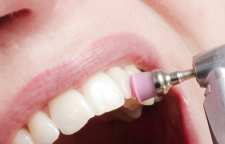 کاهش پوسیدگی دندان با بروساژ و جرم گیری دندان