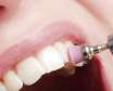 کاهش پوسیدگی دندان با بروساژ و جرم گیری دندان