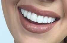 هر آنچه که در مورد کامپوزیت دندان  باید بدانید