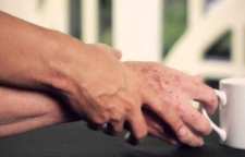 بیماری پارکینسون و علائم آن