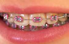 دانستنی های لازم در مورد ارتودنسی