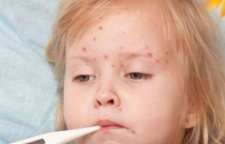 علائم آبله مرغان و پیشگیری از ابتلا به آن