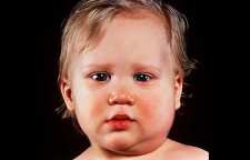 علائم بیماری اوریون و درمان آن