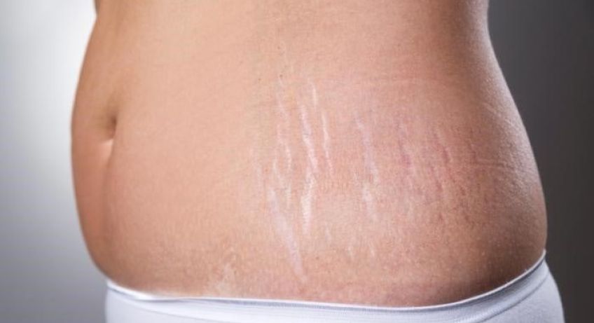درمان ترک های پوستی با روش های خانگی