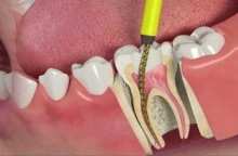 در مورد پرکردن دندان تا درد بعد از آن بیشتر بدانیم