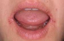دلایل ترک گوشه لب و درمان آن