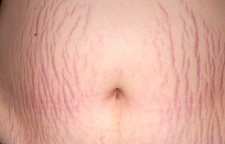 پیشگیری از ترک خوردن پوست شکم در دوران بارداری