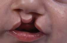 لب شکری یا شکاف کام چیست و چه دلایلی منجر به شکاف کام می شوند