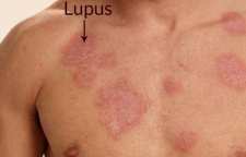 علائم بیماری لوپوس
