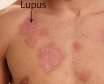 علائم بیماری لوپوس