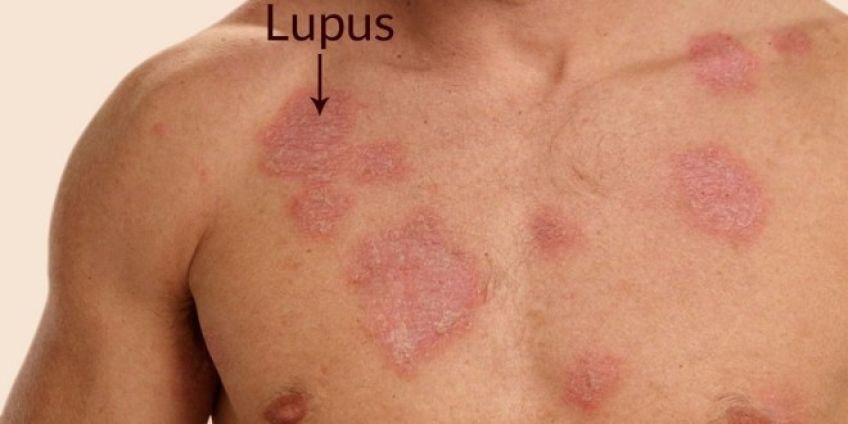 علائم بیماری لوپوس