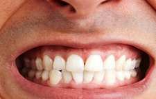 دندان قروچه و درمان آن