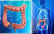 التهاب آپاندیس و علائم آن