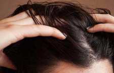 روش های درمان و از بین بردن شپش و رشک موی سر