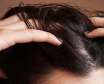 روش های درمان و از بین بردن شپش و رشک موی سر
