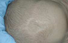 مراقبت های لازم از ملاج یا نقاط نازک سر نوزاد