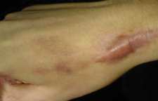 روش های خانگی برای از بین بردن لکه و جای سوختگی پوست