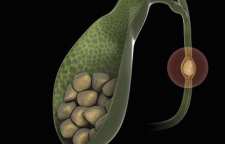 بیماری سنگ صفرا و درمان آن