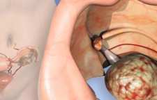 انواع سرطان تخمدان و درمان آن