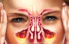 سینوزیت و درمان خانگی آن