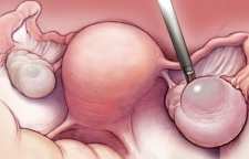 انواع کیست و درمان آن