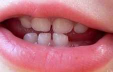 دندان نوزاد چه زمانی رشد می کند و علائم آن چیست