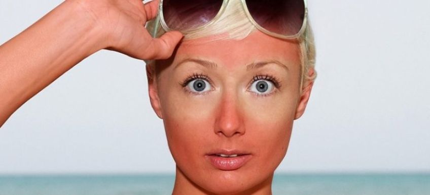 روش های مفید برای درمان خانگی آفتاب سوختگی