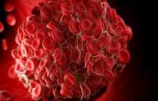 علائم لخته شدن خون و انواع لخته های خطرناک