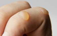 درمان تاول با روش خانگی و طبیعی