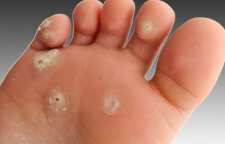 دلایل ایجاد میخچه و درمان آن