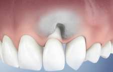 رابطه بهداشت لثه با دیابت نوع 2