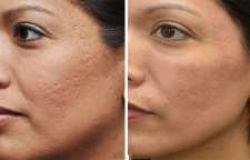 روش های مختلف درمان فرو رفتگی و اسکار جای جوش صورت