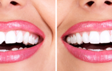 باندینگ دندان و درمان پوسیدگی یا فواصل دندانی و شکستگی با این روش