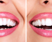 باندینگ دندان و درمان پوسیدگی یا فواصل دندانی و شکستگی با این روش