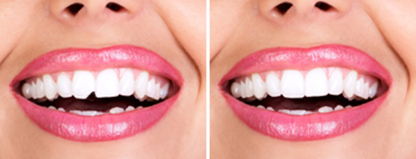 باندینگ دندان و درمان پوسیدگی یا فواصل دندانی و شکستگی با این روش