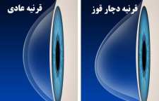 علل قوز قرنیه و راه های درمان آن