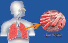 بیماری سل و علائم آن