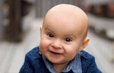 عوامل موثر بر ریزش موی نوزاد