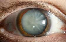 علائم آب مروارید و درمان طبیعی آن