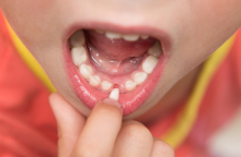 زمان طبیعی افتادن دندان شیری