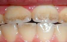 چه کار کنیم دندان کودکان با قطره آهن سیاه نشود