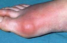 بیماری نقرس و راه های درمان آن