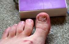 دلایل جدا شدن ناخن از بستر و راه های درمان آن